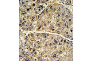 Formalin-fixed and paraffin-embedded human hepatocarcinoma with COL6A1 Antibody (N-term), which was peroxidase-conjugated to the secondary antibody, followed by DAB staining.