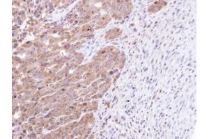 IHC-P Image Immunohistochemical analysis of paraffin-embedded NCIN87 xenograft, using STK25, antibody at 1:100 dilution. (STK25 anticorps)