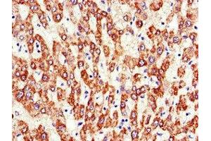 Immunohistochemistry of paraffin-embedded human liver cancer using ABIN7144836 at dilution of 1:100 (ATP5F1A (AA 59-257) anticorps)