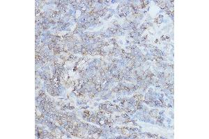 Immunohistochemistry of paraffin-embedded human lung cancer using [KO Validated] CD44 Rabbit pAb (ABIN6127602, ABIN6138193, ABIN6138195 and ABIN7101398) at dilution of 1:250 (40x lens).