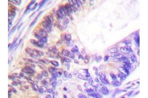 Immunohistochemistry analyzes of Rsk-1 antibody in paraffin-embedded human colon carcinoma tissue. (RPS6KA1 anticorps)