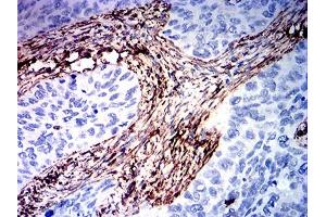 Immunohistochemical analysis of paraffin-embedded cervical cancer tissues using VIM mouse mAb with DAB staining.