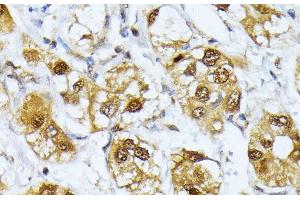 Immunohistochemistry of paraffin-embedded Human liver cancer using RRAGD Polyclonal Antibody at dilution of 1:100 (40x lens).