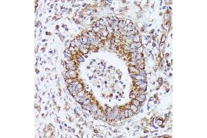 Immunohistochemistry of paraffin-embedded human colon carcinoma using DLAT antibody (ABIN7266768) at dilution of 1:100 (40x lens).