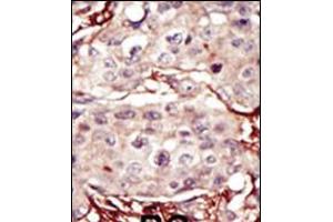 Formalin-fixed and paraffin-embedded human cancer tissue reacted with the primary antibody, which was peroxidase-conjugated to the secondary antibody, followed by DAB staining.