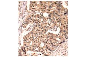 Immunohistochemistry of paraffin-embedded human breast carcinoma tissue, using Phospho-PXN-Y118 antibody (ABIN2987461). (Paxillin anticorps  (pTyr118))