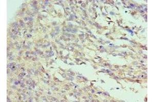 Immunohistochemistry of paraffin-embedded human cervical cancer using ABIN7156720 at dilution of 1:100 (Interleukin enhancer-binding factor 3 (ILF3) (AA 785-894) anticorps)