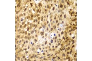 Immunohistochemistry of paraffin-embedded human lung cancer using IRF3 antibody.