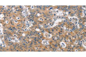 Immunohistochemistry of paraffin-embedded Human gastric cancer using CLTC Polyclonal Antibody at dilution of 1:60