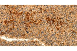 Immunohistochemistry of paraffin-embedded Human liver cancer tissue using TRPM7 Polyclonal Antibody at dilution 1:30