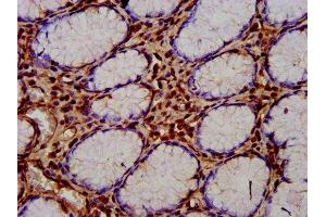 IHC image of ABIN7148543 diluted at 1:400 and staining in paraffin-embedded human gastric cancer performed on a Leica BondTM system.