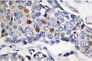 Immunohistochemistry (IHC) analyzes of POLR3A antibody in paraffin-embedded human breast carcinoma tissue. (POLR3A anticorps)