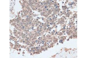 Immunohistochemistry of paraffin-embedded Human lung cancer using ZNF562 Polyclonal Antibody at dilution of 1:100 (40x lens). (ZNF562 anticorps)