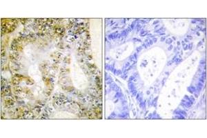 Immunohistochemistry analysis of paraffin-embedded human breast carcinoma tissue, using Catenin-beta1 Antibody. (CTNNB1 anticorps  (AA 626-675))