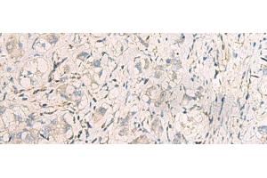 Immunohistochemistry of paraffin-embedded Human liver cancer tissue using SUSD3 Polyclonal Antibody at dilution of 1:95(x200) (SUSD3 anticorps)