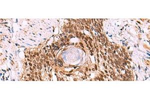 Immunohistochemistry of paraffin-embedded Human esophagus cancer tissue using LDB1 Polyclonal Antibody at dilution of 1:70(x200) (LIM Domain Binding 1 Protein anticorps)