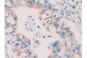 DAB staining on IHC-P; Samples: Human Bile duct cancer Tissue (KIR2DL2 anticorps  (AA 22-348))