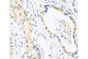 Immunohistochemistry of paraffin-embedded Human stomach cancer using POLR2E Polyclonal Antibody at dilution of 1:100 (40x lens). (POLR2E anticorps)
