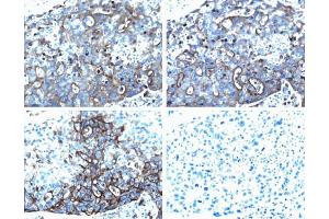 Ezrin (pT567) staining on human breast cancer.