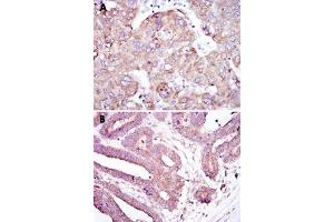 Immunohistochemical analysis of paraffin-embedded human liver cancer tissue (A) and stomach cancer tissue (B) using RBP4 monoclonal antobody, clone 4C2  with DAB staining.