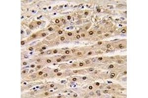 IHC analysis of FFPE human hepatocarcinoma tissue stained with anti-GAPDH antibody
