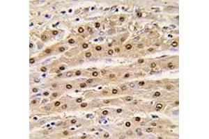 IHC analysis of FFPE human hepatocarcinoma tissue stained with anti-GAPDH antibody (GAPDH anticorps  (AA 62-91))