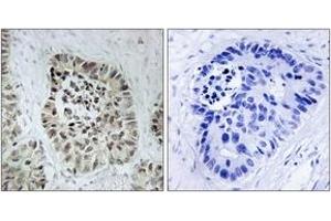 Immunohistochemistry analysis of paraffin-embedded human lung carcinoma tissue, using Artemis (Ab-516) Antibody.