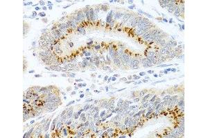Immunohistochemistry of paraffin-embedded Human colon carcinoma using FAM3B Polyclonal Antibody at dilution of 1:100 (40x lens). (FAM3B anticorps)
