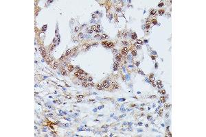Immunohistochemistry of paraffin-embedded human lung cancer using IGHMBP2 antibody (ABIN7267848) at dilution of 1:100 (40x lens). (IGHMBP2 anticorps  (AA 540-720))