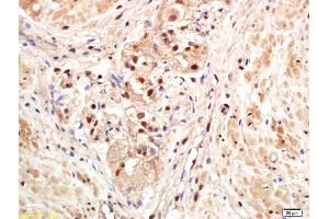 Formalin-fixed and paraffin embedded human gastric carcinoma labeled with Anti-PAPOG Polyclonal Antibody, Unconjugated (ABIN1714858) at 1:200 followed by conjugation to the secondary antibody and DAB staining. (PAPOLG anticorps  (AA 101-200))