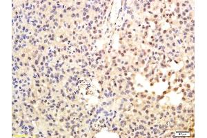 Formalin-fixed and paraffin embedded human hepatoma labeled with Anti-TRT/TERT Polyclonal Antibody, Unconjugated (ABIN726650) followed by conjugation to the secondary antibody and DAB staining (TERT anticorps  (AA 601-750))
