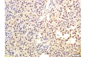 Formalin-fixed and paraffin embedded human hepatoma labeled with Anti-TRT/TERT Polyclonal Antibody, Unconjugated (ABIN726650) followed by conjugation to the secondary antibody and DAB staining (TERT anticorps  (AA 601-750))