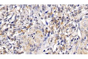 Detection of BAD in Human Ovarian cancer Tissue using Polyclonal Antibody to Bcl2 Associated Death Promoter (BAD)