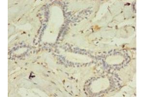 Immunohistochemistry of paraffin-embedded human breast cancer using ABIN7158507 at dilution of 1:100 (ACSL4 anticorps  (AA 457-670))