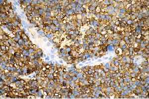 Immunohistochemistry was performed on paraffin-embedded human glioblastoma using tubulin III antibody (ABIN7800669), 1:500). (Recombinant TUBB3 anticorps)