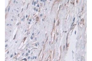 Detection of CPA4 in Human Prostate cancer Tissue using Polyclonal Antibody to Carboxypeptidase A4 (CPA4) (CPA4 anticorps  (AA 55-421))