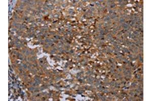 The image on the left is immunohistochemistry of paraffin-embedded Human cervical cancer tissue using ABIN7191748(OTOR Antibody) at dilution 1/30, on the right is treated with synthetic peptide. (Otoraplin anticorps)