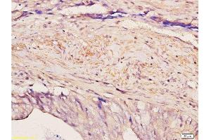 Formalin-fixed and paraffin embedded human colon carcinoma with Anti-Pokemon Polyclonal Antibody, Unconjugated  at 1:200, followed by conjugation to the secondary antibody and DAB staining (ZBTB7A anticorps  (AA 151-250))