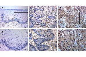 Immunohistochemical staining of TEAD4 in human HNSCC samples. (TEAD4 anticorps  (Center))
