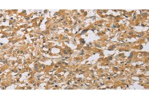 Immunohistochemistry of paraffin-embedded Human thyroid cancer tissue using ARHGEF1 Polyclonal Antibody at dilution 1:50