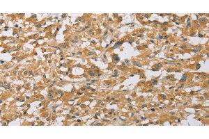 Immunohistochemistry of paraffin-embedded Human thyroid cancer tissue using ARHGEF1 Polyclonal Antibody at dilution 1:50 (ARHGEF1 anticorps)