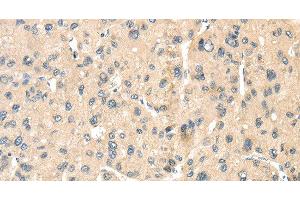 Immunohistochemistry of paraffin-embedded Human liver cancer tissue using LOXL3 Polyclonal Antibody at dilution 1:35 (LOXL3 anticorps)