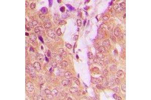 Immunohistochemical analysis of TPH1 staining in human breast cancer formalin fixed paraffin embedded tissue section.