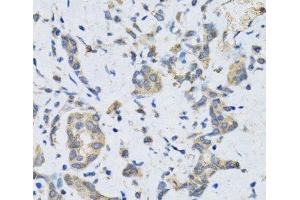 Immunohistochemistry of paraffin-embedded Human gastric cancer using SLC2A13 Polyclonal Antibody at dilution of 1:100 (40x lens). (SLC2A13 anticorps)