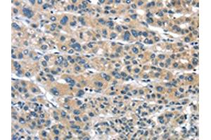 The image on the left is immunohistochemistry of paraffin-embedded Human liver cancer tissue using ABIN7192957(TUSC1 Antibody) at dilution 1/30, on the right is treated with synthetic peptide.