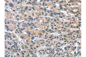 The image on the left is immunohistochemistry of paraffin-embedded Human liver cancer tissue using ABIN7192957(TUSC1 Antibody) at dilution 1/30, on the right is treated with synthetic peptide. (TUSC1 anticorps)