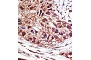 Formalin-fixed and paraffin-embedded human cancer tissue reacted with the primary antibody, which was peroxidase-conjugated to the secondary antibody, followed by AEC staining.