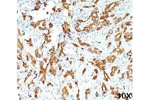 IHC testing of human breast carcinoma (10X) stained with HSP27 antibody (G3. (HSP27 anticorps)