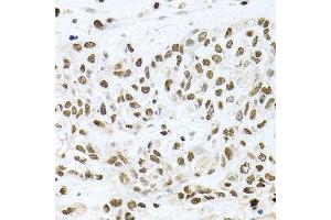 Immunohistochemistry of paraffin-embedded human lung cancer using BCCIP antibody. (BCCIP anticorps  (AA 1-314))