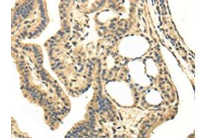 The image on the left is immunohistochemistry of paraffin-embedded Human thyroid cancer tissue using ABIN7130215(MED16 Antibody) at dilution 1/20, on the right is treated with fusion protein. (MED16 anticorps)